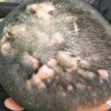 头皮真菌感染怎么治疗