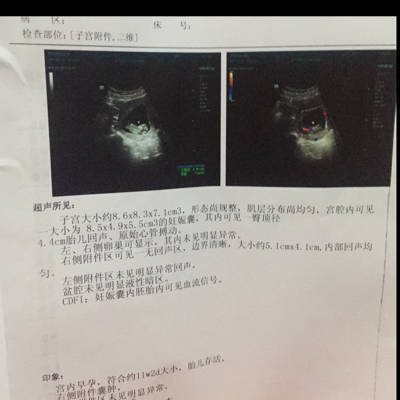 怀孕11周宝宝多大图片