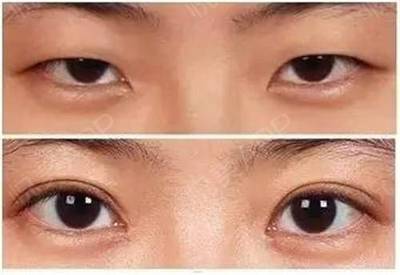 双眼皮有几种做法