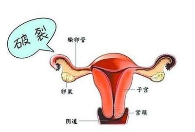 怀孕拉屎出血