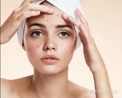 为什么痘痘总是反反复复