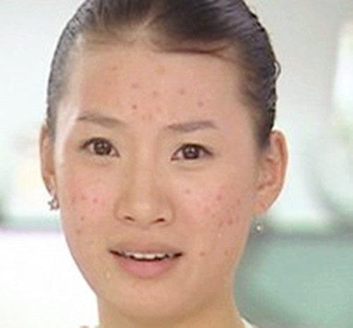 长痘痘能用牛奶洗脸吗