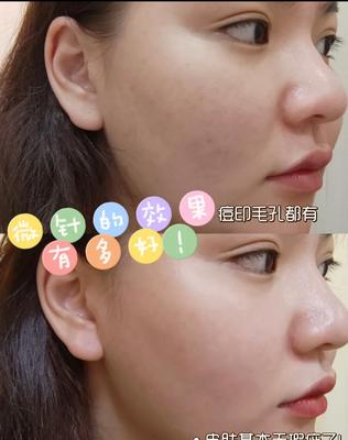 微针美容好不好