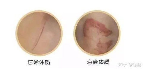 怎么判断自己是疤痕体质