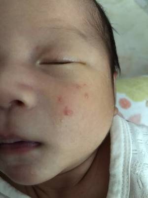 新生儿脸上长了很多小红点
