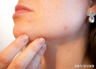吃什么容易长痘痘
