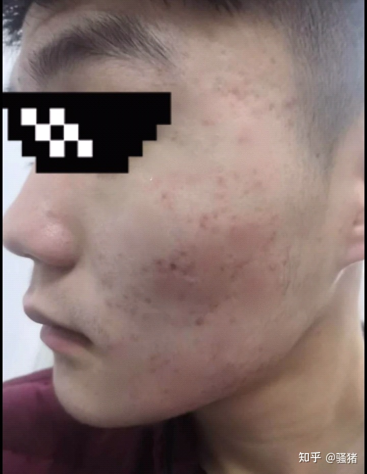 脸上没痘痘有红色痘印