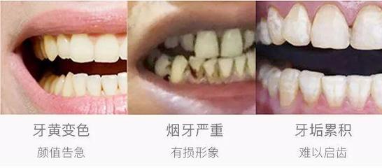 牙齿里面发黑是怎么回事