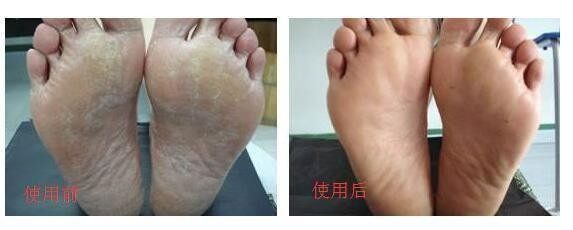 泡脚脚起泡是怎么回事
