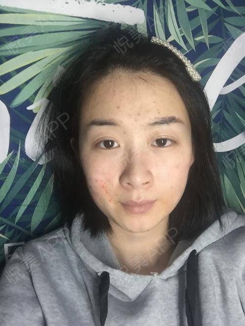 青春痘疤痕修复