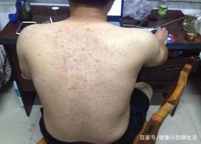 背部出痘痘怎么治疗方法