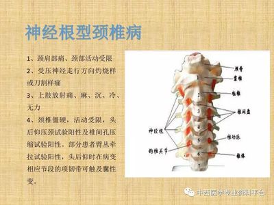 神经根颈椎病怎么治疗最好