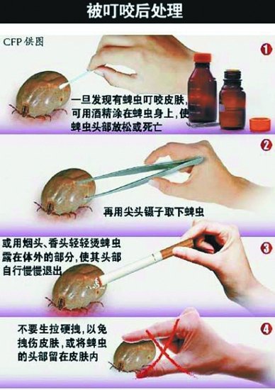 蜱虫咬人后怎么治疗