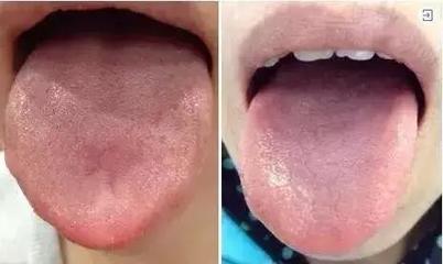 痰湿 痘痘