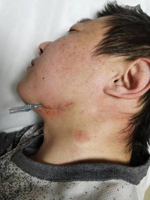 右边侧面长痘痘