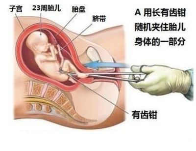 四十九天后药流后的胎盘有多少