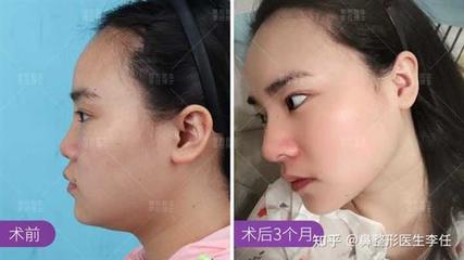 隆鼻一般需要多少钱