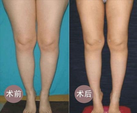 大腿抽脂减肥的费用