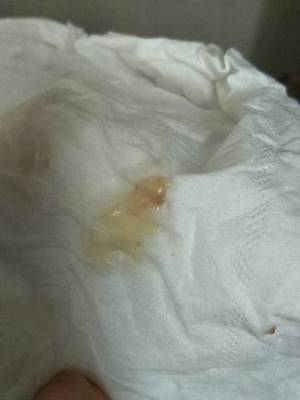 女生白带多是怀孕了吗