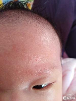 6个月宝宝出疹子症状