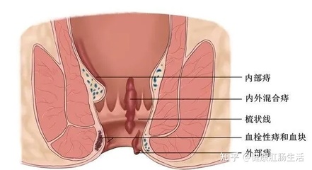 做完痔疮手术多久可以怀孕