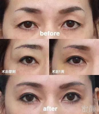 眼皮耷拉是什么病