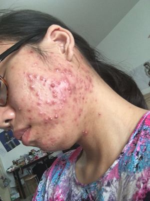 脸和下巴交界处长痘痘