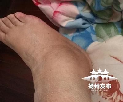 脚腕肿胀是怎么回事