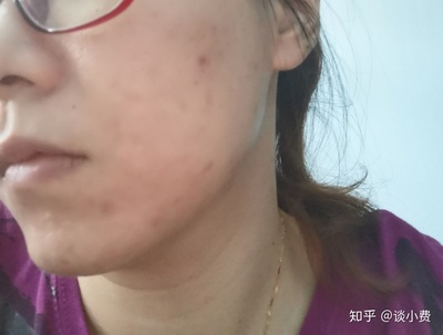 长痘痘变好的帖子