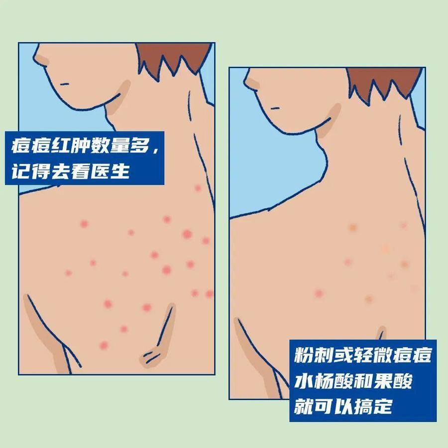 男人背上长痘痘用什么洗