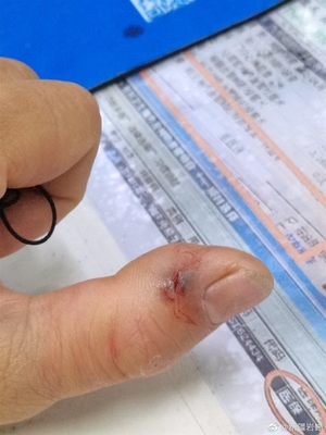 中指肿胀是怎么回事