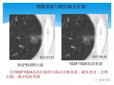 什么是ct高分辨率扫描