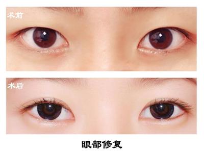 失败双眼皮修复贴吧