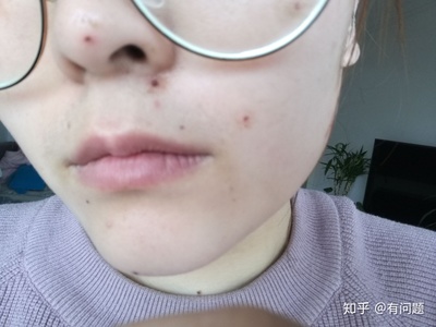 药水点痣后的恢复过程