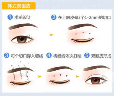 韩式做双眼皮价格