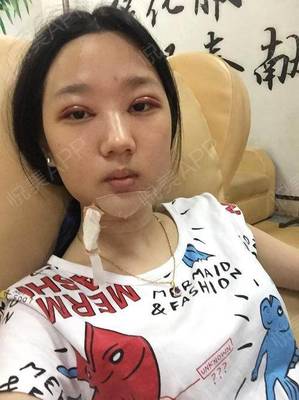 割双眼皮消炎针打几天