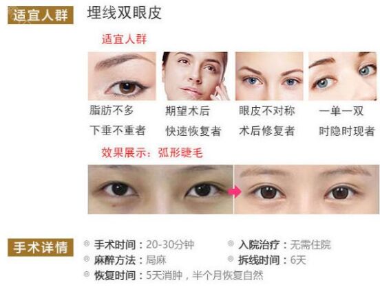 纳米双眼皮后总磨眼睛