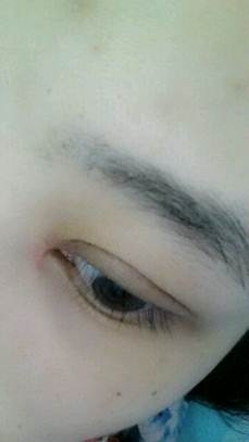 右眼皮肿是怎么回事