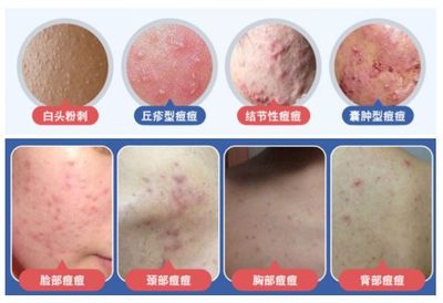 丘疹型痘痘严重么