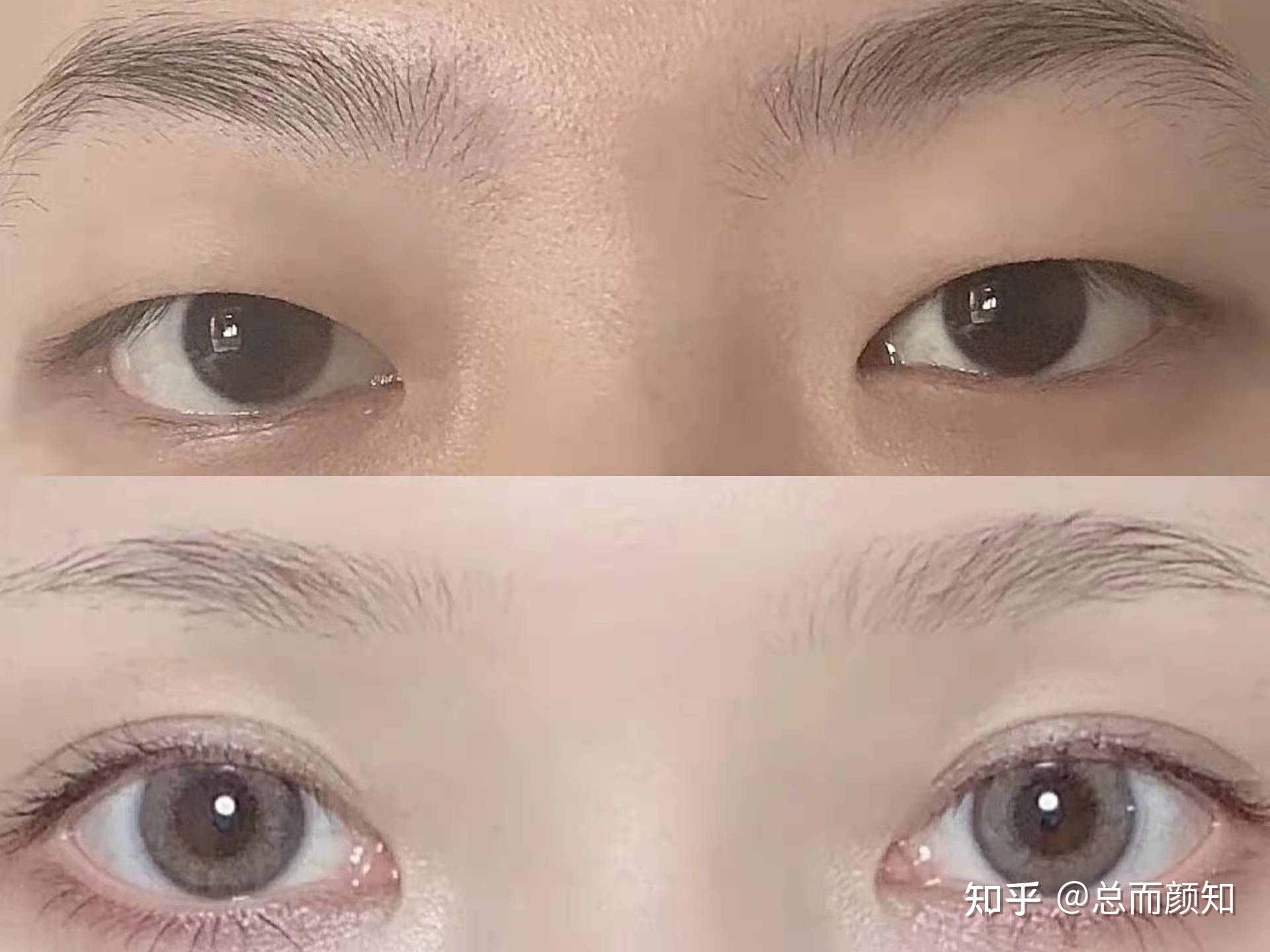 双眼皮 济南