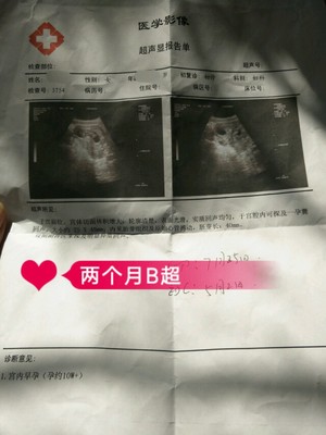 怀孕2个月最准看男女