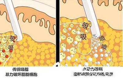 抽脂痛不痛