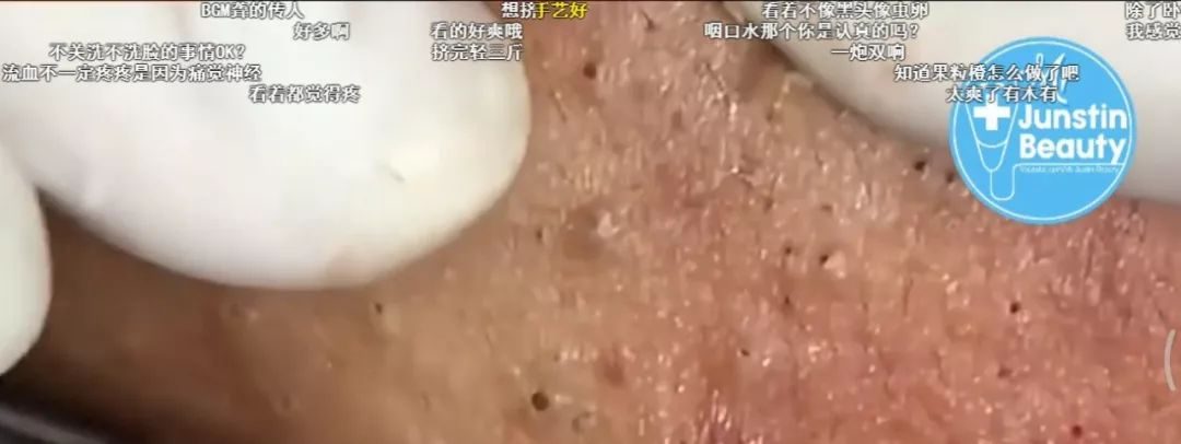 挤黑头毛孔粗大怎么办