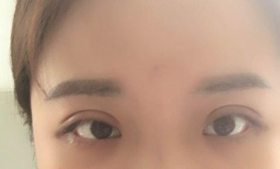双眼皮多久能吃酱油