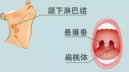 淋巴发炎是怎么回事