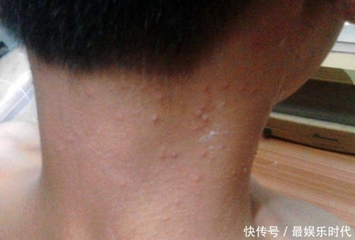 孕妇脖子上长痘痘怎么办