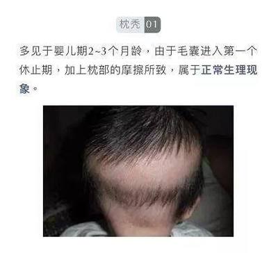 2岁多宝宝掉头发是什么原因