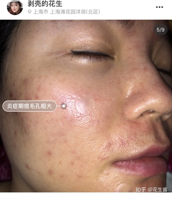 微针后长痘痘