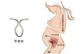 上环久了会影响怀孕吗