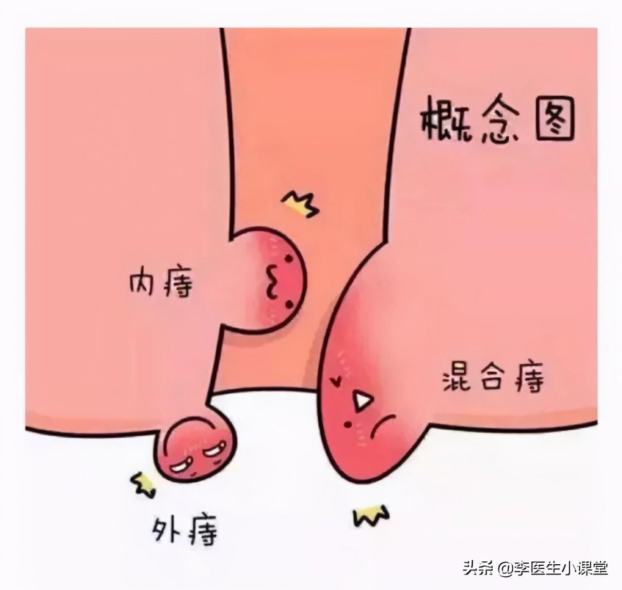内痔外痔怎么治疗